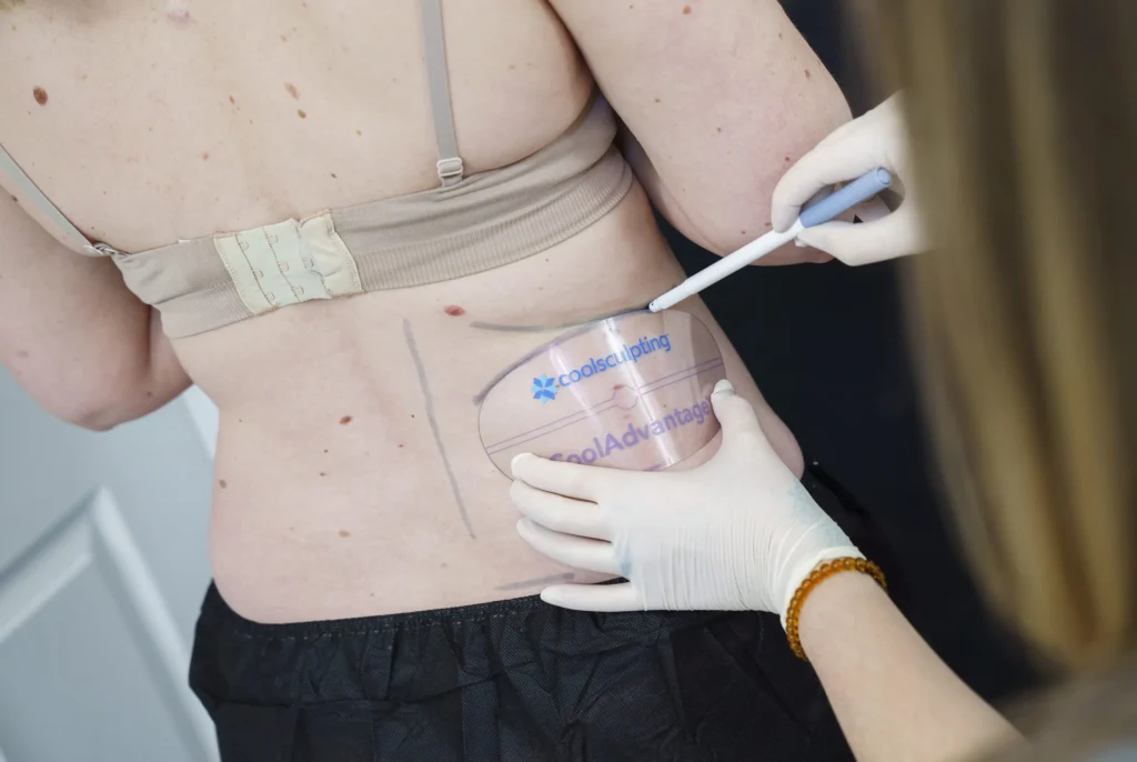 CoolSculpting Elite vs. Original CoolSculpting What Changed